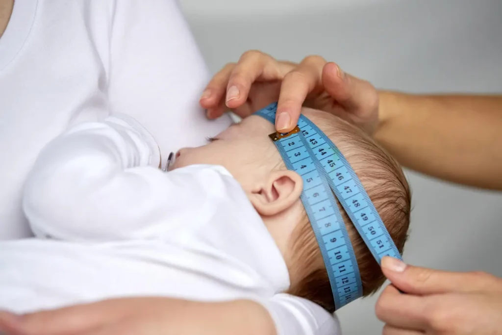 Médico usando fita métrica para medir cabeça de um bebê, durante tratamento para hidrocefalia